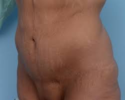 In this procedure, the skin is pulled downward and inward toward the center of the abdomen. Fleur De Lys Abdominoplasty The Cosmetic Surgery Clinic