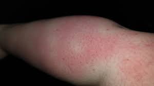 Sepsis and septic shock can result from an infection anywhere in the body, such as pneumonia, influenza, or urinary tract infections. Seeking Help And Advice Regarding My Red Hot Right Arm I Has Been Like This Since I Had My First Bout Of Sepsis 18 Months Ago A 2nd Bout Of Sepsis Made