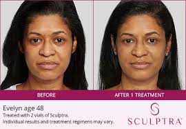 Apr 13, 2022 · sculptra® aesthetic before and after pictures. Sculptra Aesthetic Before And Afters Birmingham Al Hedden And Gunn Plastic Surgery