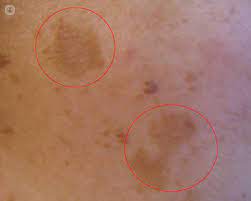 Los hongos provocan enrojecimiento e irritación de la piel, y en algunos casos hasta infecciones. Manchas En La Piel Que Es Sintomas Causas Prevencion Y Tratamiento Top Doctors