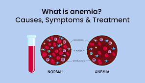 What Is Anemia? Causes, Symptoms & Treatment