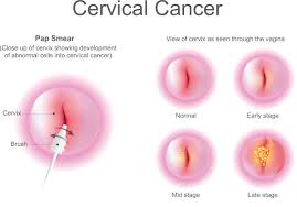 Image result for Pap Smear