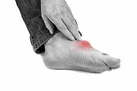 Image result for gout symptoms toe