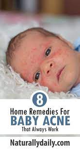 8 Safe Home Remedies For Baby Acne Babyrashestreatment Baby Acne Is Known As Erythema Toxicum Neonatorum It Baby Acne Natural Remedies Baby Baby Acne Remedy