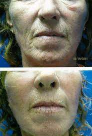 Handicare stairlifts are better than acorn stair lifts. Lifestyle Lift Cost And Reviews Facelift Info Prices Photos Reviews Q A