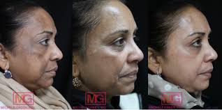 Post Laser Hyperpigmentation