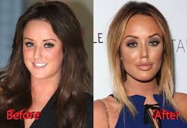 Pin On Celebrity Plastic Surgery