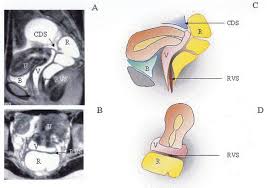 An mri lexicon for endometriosis mri evaluation and anatomic localization. A Novel Technique Using Magnetic Resonance Imaging Jelly For Evaluation Of Rectovaginal Endometriosis Fertility And Sterility