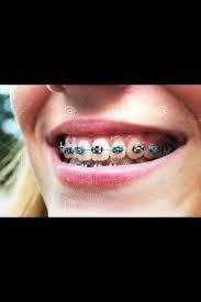 Black And Dark Purple Braces Pin By Allicia Wiley On Teenagers Braces Colors Orthodontics Braces Orthodontics