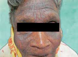 Image result for Diffuse Hyperpigmentation