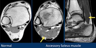 ► hip ► pelvis ► thigh ► knee ► lower extremity/shin ► ankle ► foot. The Radiology Assistant Mri Examination Of The Ankle