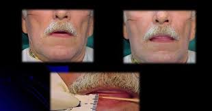 PASOS Prácticos #PrótesisTotales Parte4 Prueba  dientes/Ajustes/PrótesisTerminada #DentaduraCompleta