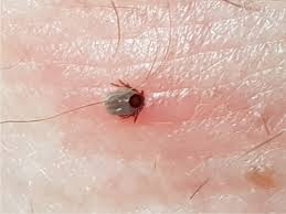 Image result for infected tick bite