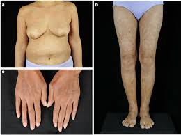 Image result for Diffuse Hyperpigmentation