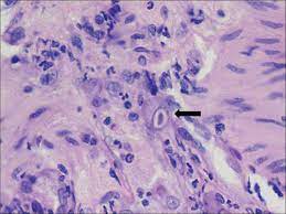 If you have a health. Esophageal Ulcer In A Hiv Seropositive Patient Co Infected By Herpes Simplex And Cytomegalovirus Srilatha P S Suvarna N Gupta A Bhat G Indian J Pathol Microbiol