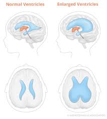Image result for Hydrocephalus