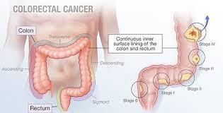 Image result for Colorectal Cancer