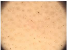 Hair follicles also anchor hair to your skin. Alopecia Areata Black Dots Are Observed Inside The Yellow Dots And Download Scientific Diagram
