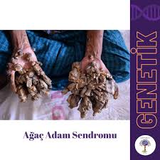 Stone man syndrome and tree man syndrome are rare genetic disorders that transform your body from the inside out. Platform Bilim On Twitter Agac Adam Sendromu Nedir Genetik Biyoloji Kalitsal Genetic Biology Sendrom Treeman Hereditary Gene The Tree Man Syndrome Is A Rare Genetic Condition It Is Caused By A