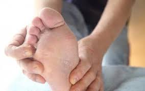 Maybe you would like to learn more about one of these? Bikin Kulit Gatal Begini Cara Mudah Atasi Kutu Air Akibat Banjir Okezone Lifestyle