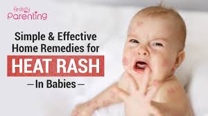 Image result for sweat rash on back baby