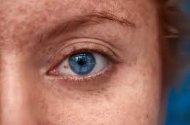 Image result for melanosis sclera