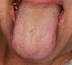 Image result for brown tongue symptoms