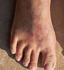 Image result for Stasis Dermatitis