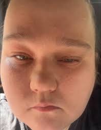 I have a headache in left side of my head since I start the aligner has any  one have that?