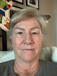 Lasik surgery recommendations please.