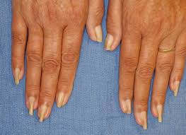 It can be confused with unilateral. Acquired Pincer Nail Deformity Associated With End Stage Renal Disease Secondary To Diabetes