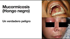 Check spelling or type a new query. Mucormicosis Hongo Negro Informacion Que Debes Conocer Video En Contexto