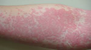 Coronavirus Skin Rash Can Be Only Covid 19 Symptom And Should Be Fourth Key Sign Study Finds Uk News Sky News