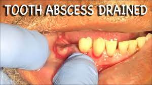 Infected Tooth Abscess Drained | Graphic⚠️ - Youtube