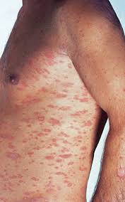 Die behandlung erfolgt mit antipilzmitteln ( antimykotika ), wobei zumeist eine lokale anwendung (als creme, shampoo) ausreicht. Haufige Hauterkrankungen Tipps Fur Die Hausarztpraxis Dermatosen