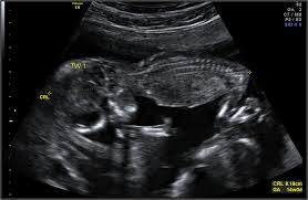 We did not find results for: Pregnancy Week 14