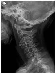 Un resultado normal significa que la parte de la columna que pasa a través del cuello y los nervios cercanos tiene apariencia normal. Dolor Cervical En Paciente Pediatrico