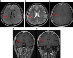 Image result for Neurosyphilis