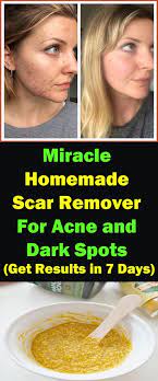 Diy Acne Face Mask Recipes Acne Face Mask Recipe Scar Removal Diy Acne Scar Treatment