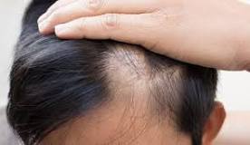 Image result for when to consider hair loss treatment