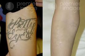As a result, they often offer a better price range than the other facilities that have more than one area of expertise. Laser Tattoo Removal Atlanta Ga