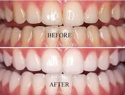 Check spelling or type a new query. Why Your Teeth Aren T White And What You Can Do About It