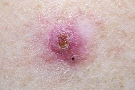 See pictures of these signs of squamous cell carcinoma. Types Of Skin Cancer