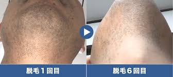 ミュゼ メンズ 脱毛