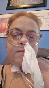 Why does my nose run all the time with cystic fibrosis?