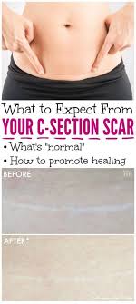Pin On After C Section Care And Easy Meals