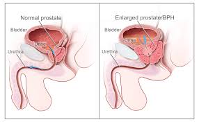 The urethra, which is the tube that goes from the bladder to the. Benign Prostatic Hyperplasia Wikipedia