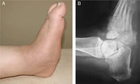 Charcot foot is a condition causing weakening of the bones in the foot that can occur in people who have significant . Rocker Bottom Charcot Foot A Clinical Appearance B Lateral Radiograph Download Scientific Diagram