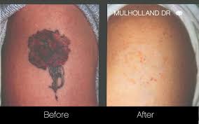 Tattoo removal works by breaking up the ink particles in the skin, which your immune system then clears away (i.e. Laser Tattoo Removal Clinic Toronto See Our Before Afters