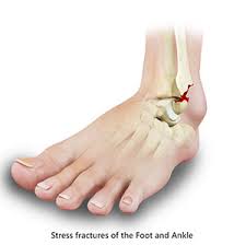 The reason i mention this is because many people seem to think there has to be some kind of trauma to the bone in order for it to break. Foot Stress Fracture Sydney Nsw Foot Injury Randwick Foot Fracture